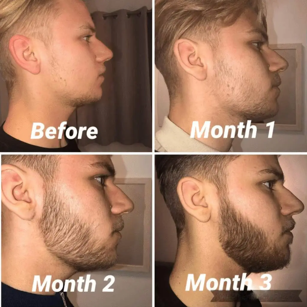 Прибор для роста бороды