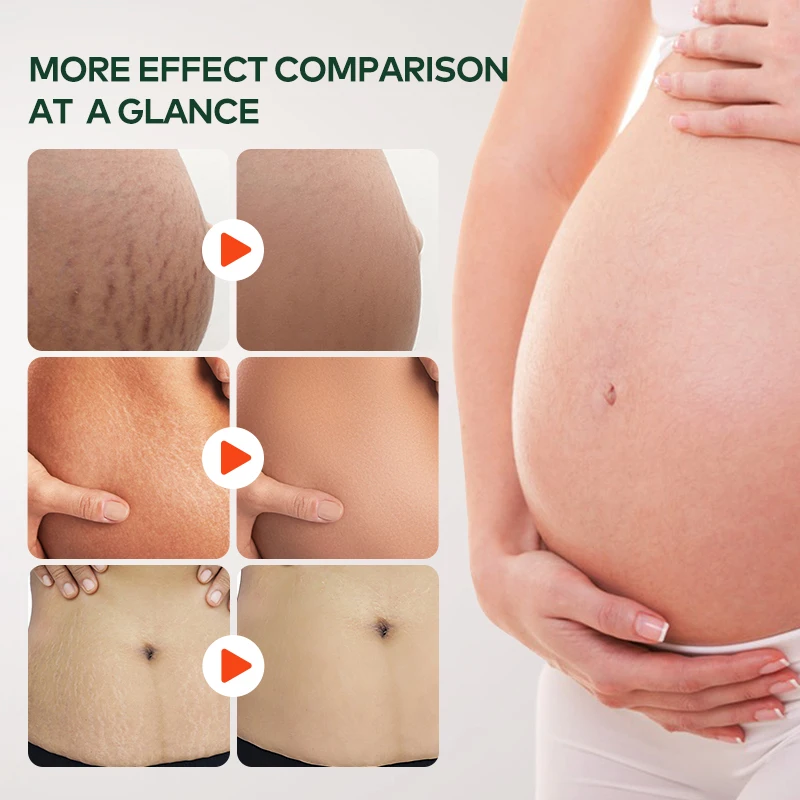 Private Label Natural Marks & Scars Repair Skin Nourishing Smoothing Message Oil Natural Stretch Mark Oil(pic3)