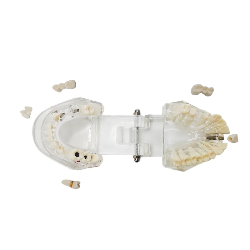 Прозрачная модель зубов для коррекции полости рта съемный имплантат дисплей ногтей обучающая