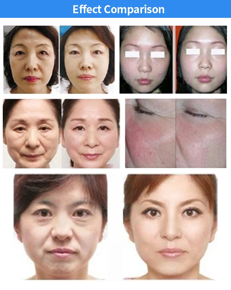 Fractional Rf Radio Frequency Dot Matrix Cooling Skin Rejuvenation Face Lifting Skin Tightening for Salon