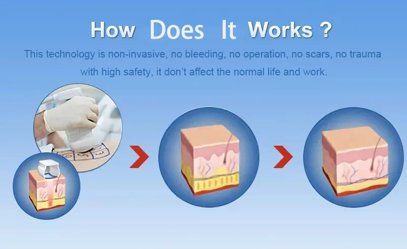 Discover the LipoSonic HIFU Machine for non-invasive fat reduction and body sculpting. Advanced ultrasound technology delivers targeted fat destruction, skin tightening, and visible slimming results for professional clinics and med spas. LipoSonic HIFU Machine for Body Slimming Weight Loss