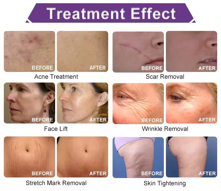 Facial Radio frequency vacuum rf Skin Tightening Rf Microneedling Machine