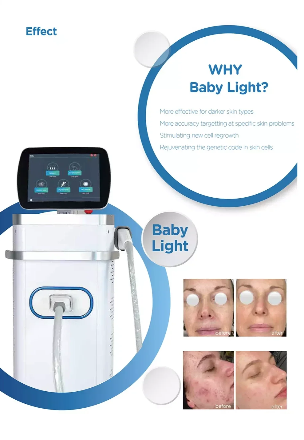 ADSS BBL Hero NIR OPT Skin Rejuvenation IPL Laser Hair Removal Machine for Commerical Salon