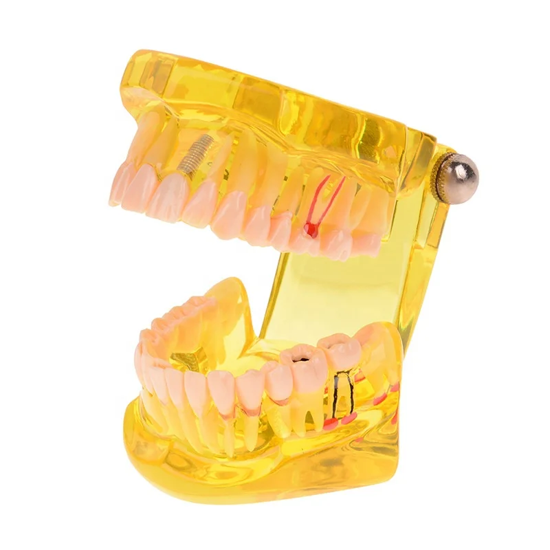Oral Bridge Model Movable Tooth Model Removable Implant Model - Buy ...