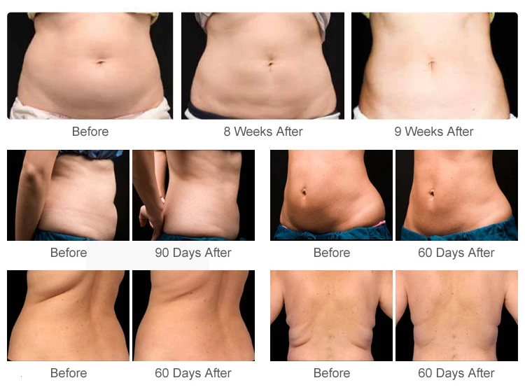 <p data-pm-slice="1 3 []">The Cryolipolysis and Body Slimming Machine is a multifunctional body contouring system designed for professional aesthetic salons, Med Spas, and beauty clinics. Combining controlled cooling, 40KHz ultrasonic cavitation, 6-polar radiofrequency (RF), and laser lipolysis in one platform, it offers multiple treatment modalities for customized body contouring services.</p> The system includes four cryolipolysis applicators—2 large, 1 medium, and 1 small—alongside dedicated cavitation, RF, and laser lipolysis attachments. With adjustable vacuum pressure of 0–80 kPa and a cooling range of -10°C to 10°C, it provides versatile configuration options for professional body treatment protocols. <strong>Key Features</strong> <ul data-spread="false"> <li>Multiple technologies integrated into one body contouring platform</li> <li>Four cryolipolysis applicators in three sizes</li> <li>40KHz ultrasonic cavitation</li> <li>6-polar RF handpiece for body contouring applications</li> <li>Laser lipolysis attachments with specified 100 mW-per-emitter output, subject to manufacturer confirmation</li> <li>Adjustable negative pressure from 0 to 80 kPa</li> <li>Dual-voltage options for different electrical markets, subject to configuration confirmation</li> </ul> Cryolipolysis Body Slimming Machine with Cavitation RF & Laser Lipolysis