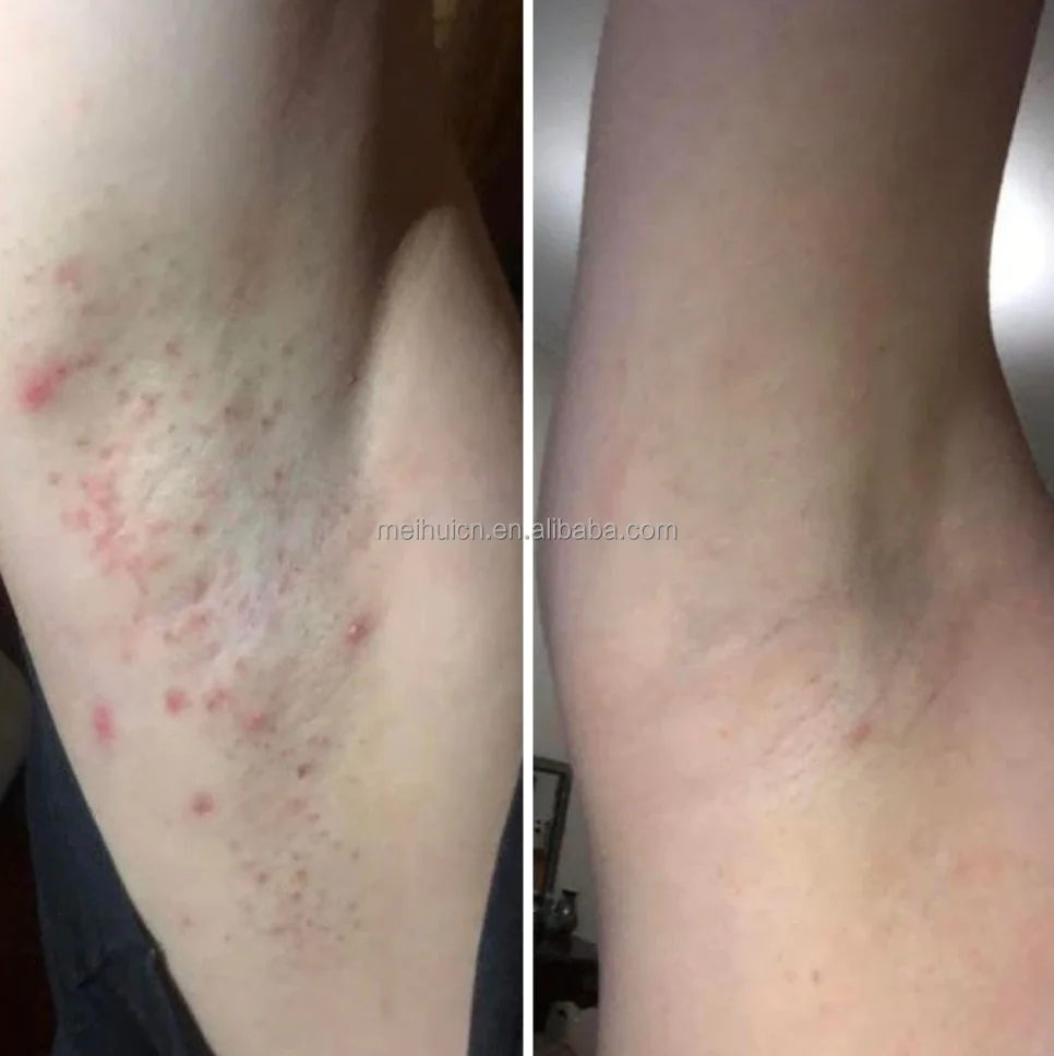 Vello Enquistado Vellos Enterrados Axilas Piel Como Sacar Pelos