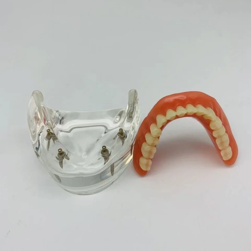 Kyrenmed Dental Four-implant Locator Abutment Lower-overdenture Model ...