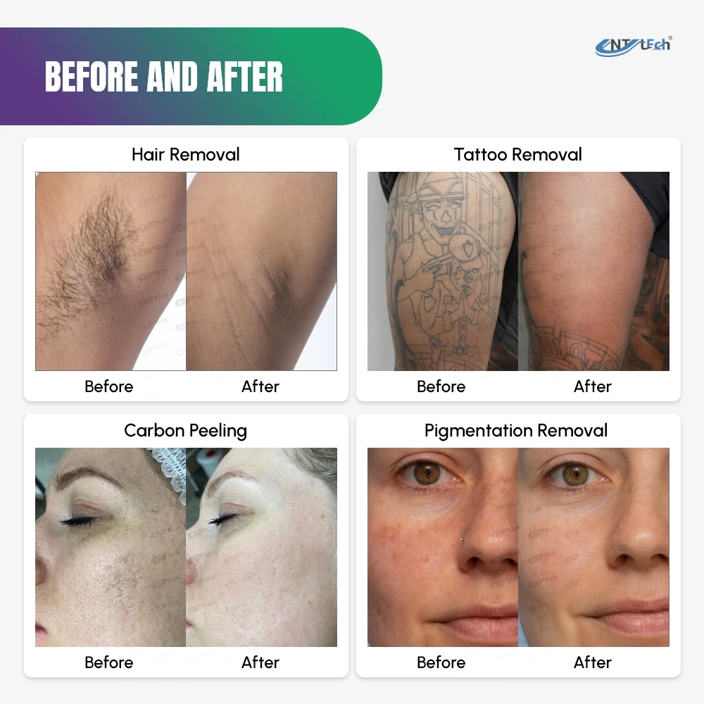 Smart Clinic 2 in 1 Diode Laser Hair Removal 755 808 1064 Nd Yag Laser Tattoo Removal Laser Hair Removal Machine