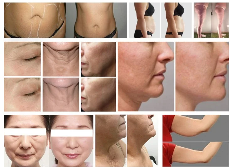 Vacuum Laser rf cavitation rf vacuum led machine