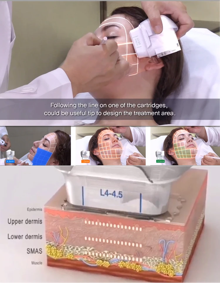 2023 New Model Gold TT 12 D Face Lift Machine 2 in 1 Rotating 360 12D Hifu Mmfu MPTSTL