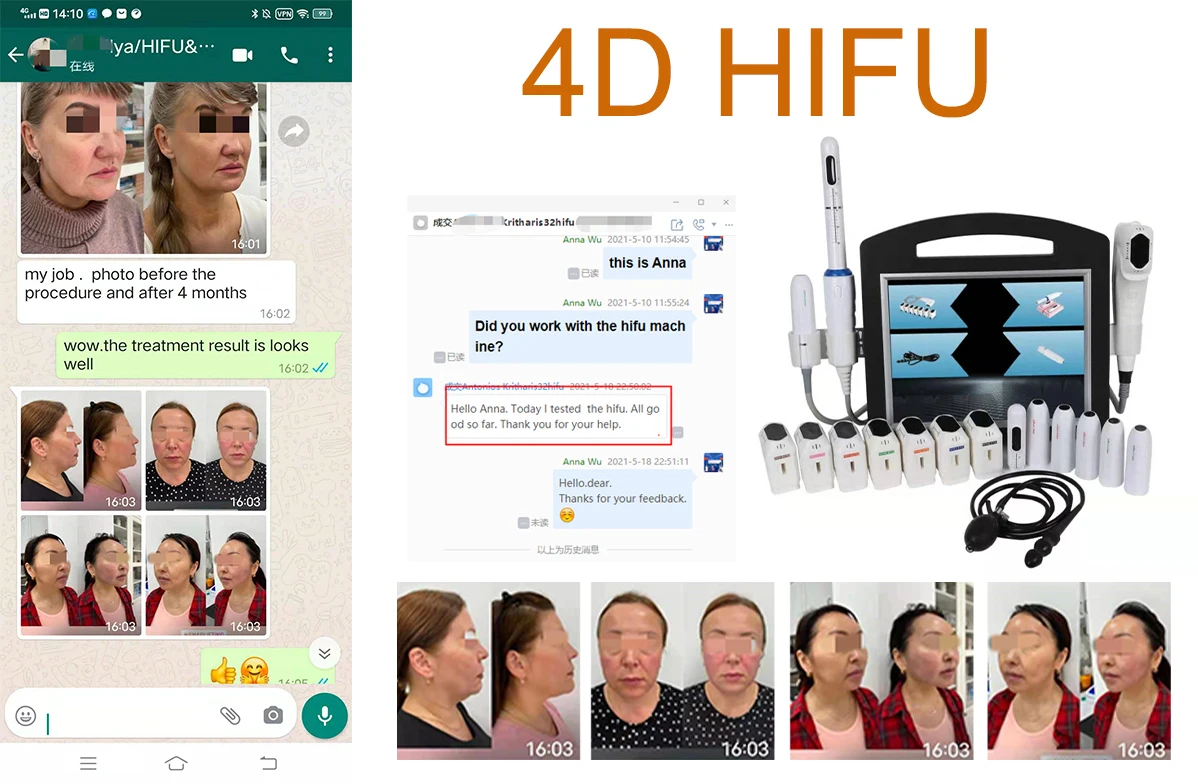 4d hifu good feedback.jpg