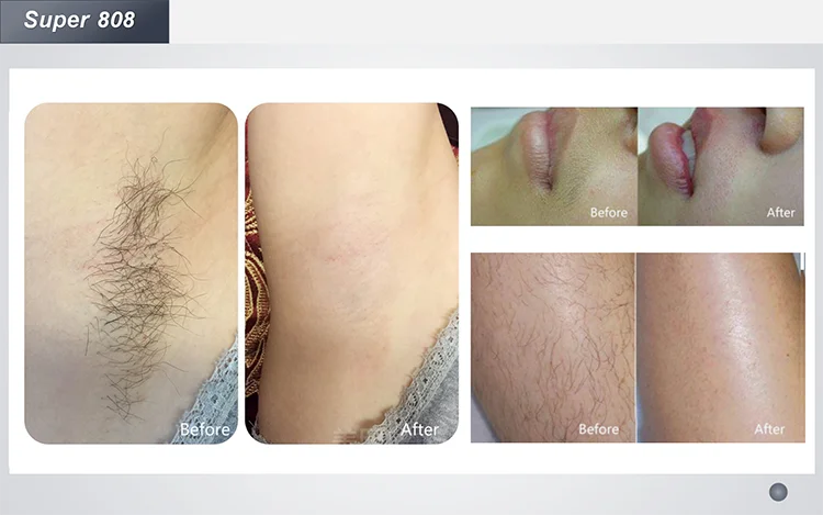 2023 Hot Sale Professional Beauty Machine Laser 808nm Hair Removal Diode 808 755 1064 Diode Laser Hair Removal