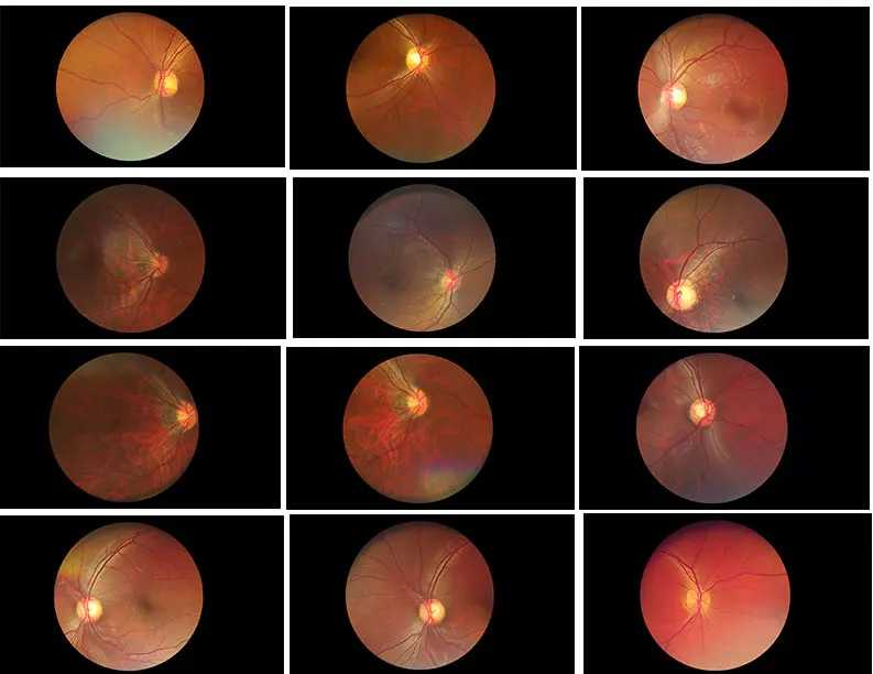 Test Machine Digital Smartphone Enabled Retin Fundus Camera, Handheld Eye Portable Fundus Retinal Camera