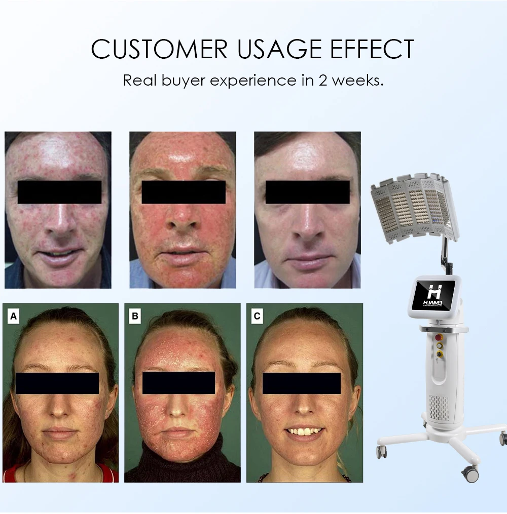Pdt Facial PDT Light Photo Dynamic Therapy Light Facial Therapy Machine ...
