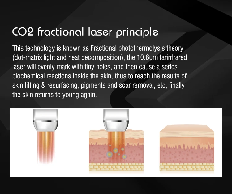 CO2 fractional laser principle: micro columns with untreated skin between them