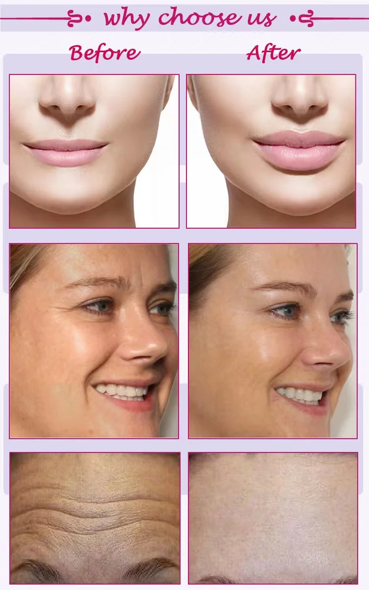 Hereme hyaluronic acid inject dermal filler injection facial fillers for lips acido hialuronico inyectable reticulado