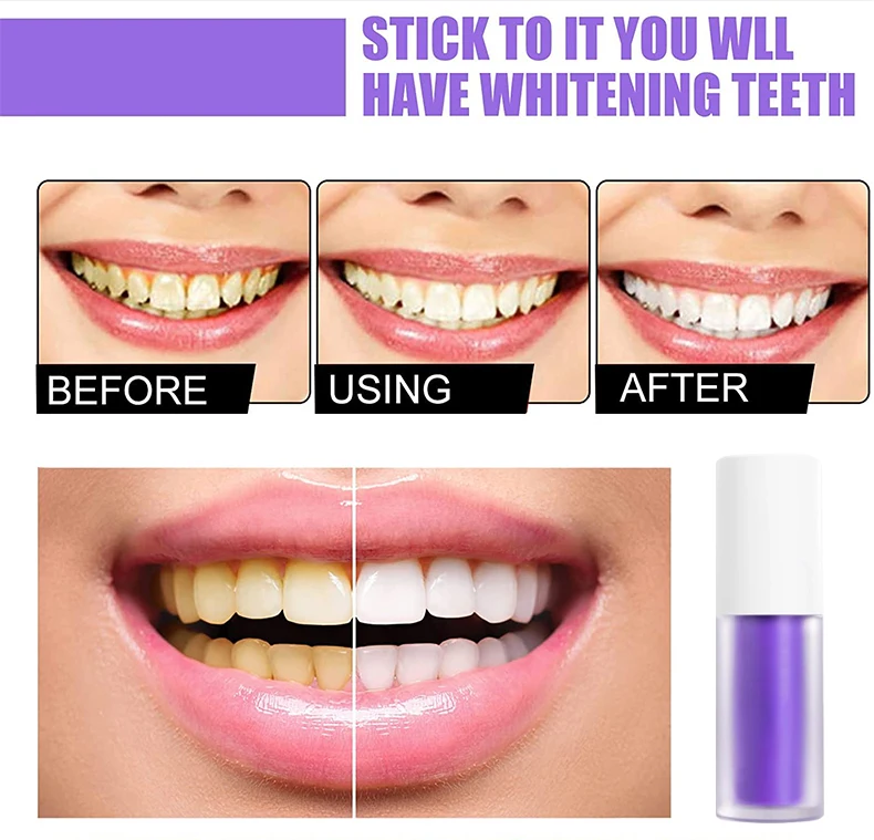 Stylo Blanchiment Dentaire Lanthome V34 - Gel éclaircissant, Sans Alcool, 30g, PAO 36 Mois