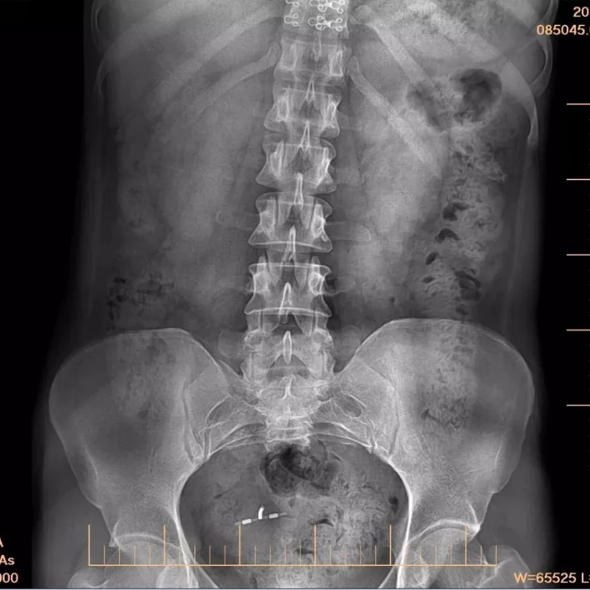 Hot Sale X Ray Fat Panel Dedektor Wired DR Flat Panel Detector for Hospital Use supplier