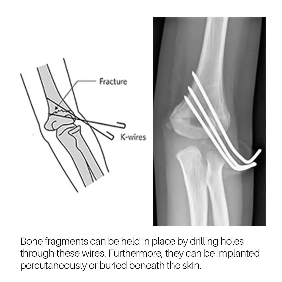 Orthopedic Surgical Instruments Double End Titanium K Wire Needle Kirschner Tip Orthopedic K Wire 6