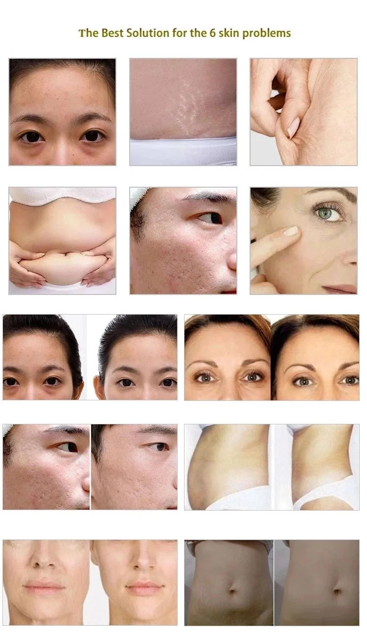 Carboxiterapia Maquina Carboxy Therapy Stretch Marks Eyes Dark Circles