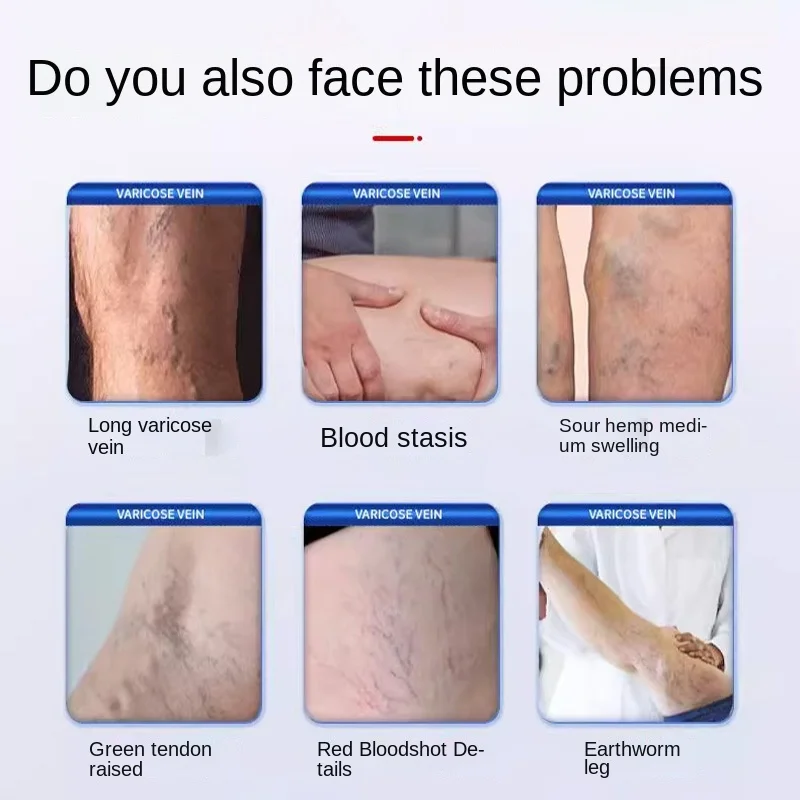 Effective Leg Vein Care Cream Chinese Plaster for Adults-Phlebitis Vasculitis Relief Improves Blood Circulation Soothes Varicose