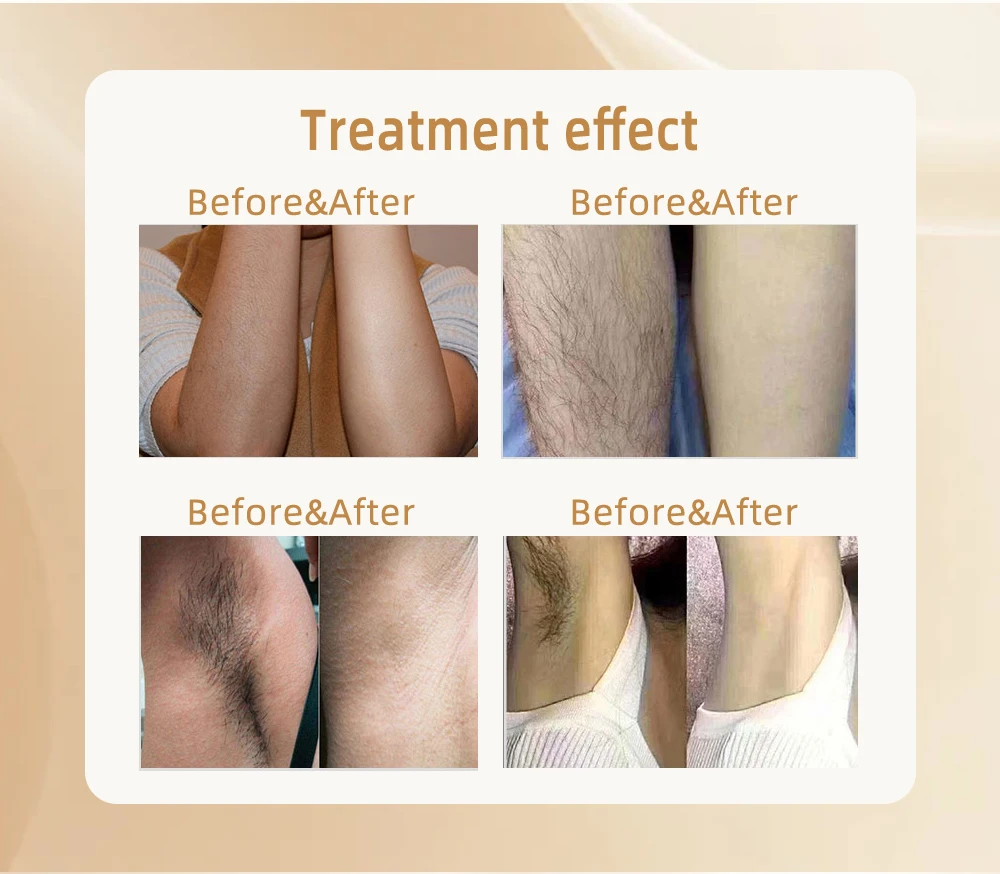 Professional 3-wavelength diode laser hair removal machine featuring 755nm, 808nm, and 1064nm technology. Designed for permanent hair reduction on all skin types with advanced cooling, high power output, and fast treatment speed. Ideal for salons and aesthetic clinics. Titanium Ice 3-Wavelength Diode Laser Hair Removal Machine (755nm + 808nm + 1064nm)