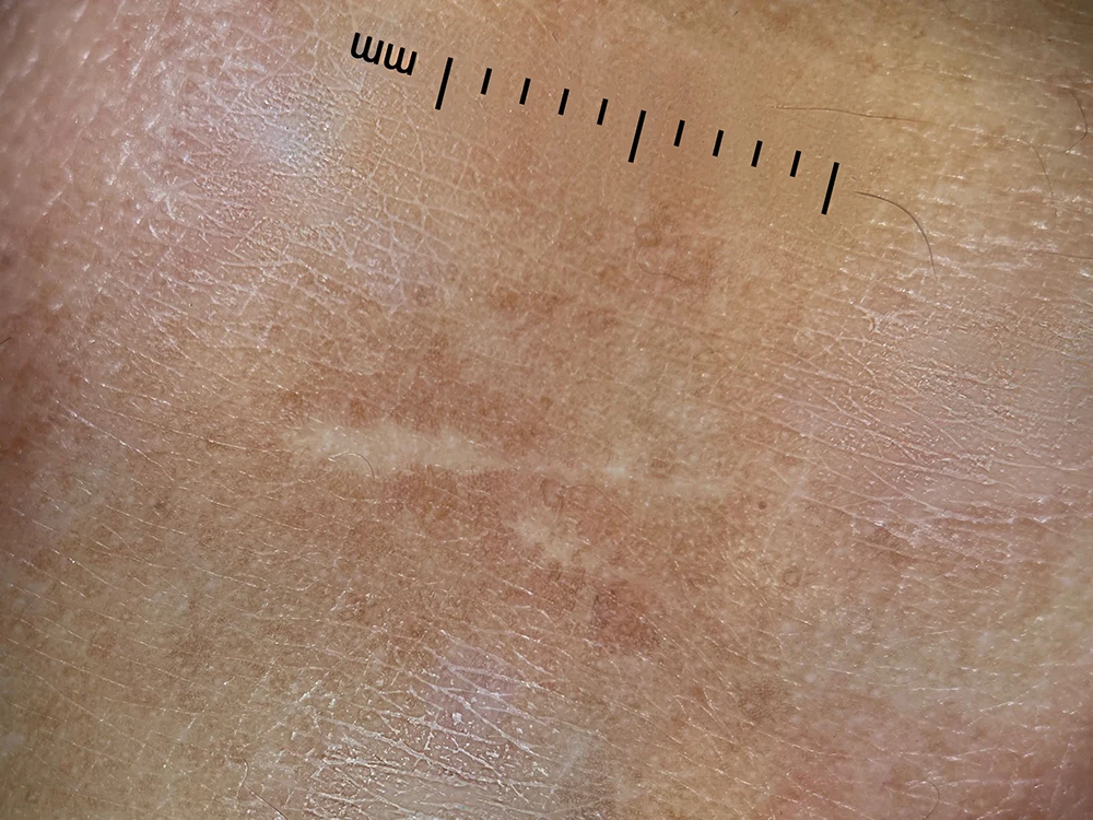 IBOOLO DE-300 для домашнего использования поляризованный дерматоскоп