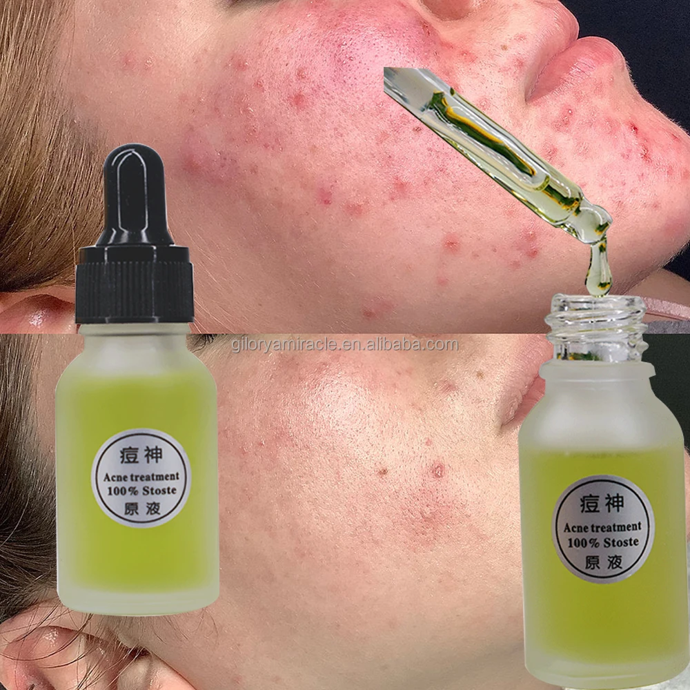 For Sensitive Skin Fight Bacteria Treat Acneprone Blemishes Pimples