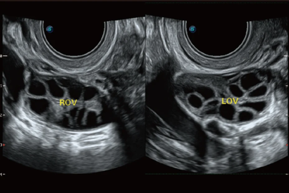 Sonoscape P20 Mobile 3D/4D Real-time Color Panoramic Doppler Trolley Ultrasound Machine supplier