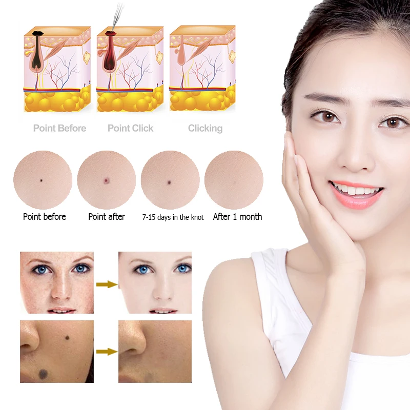 9 Level LCD Plasma Pen Mole Tattoo Freckle Wart Tag Removal Pen Dark Spot Remover for Face Skin Care Tool Beauty Machine