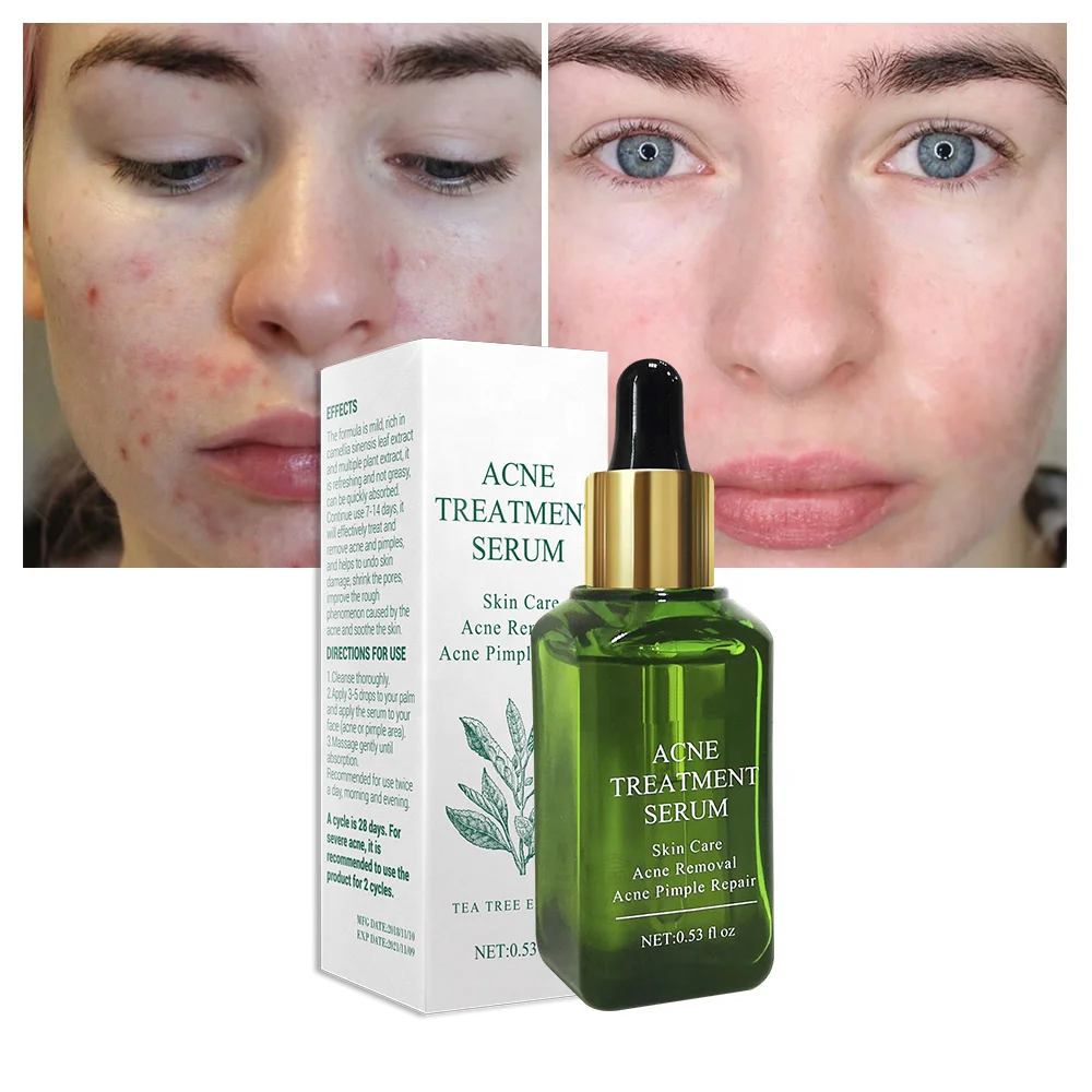 serum acne whitening
