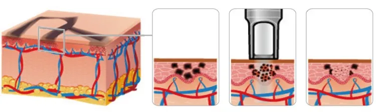 Hot sell Mini eyebrow washing machine nd yag pico laser tattoo removal pico machine