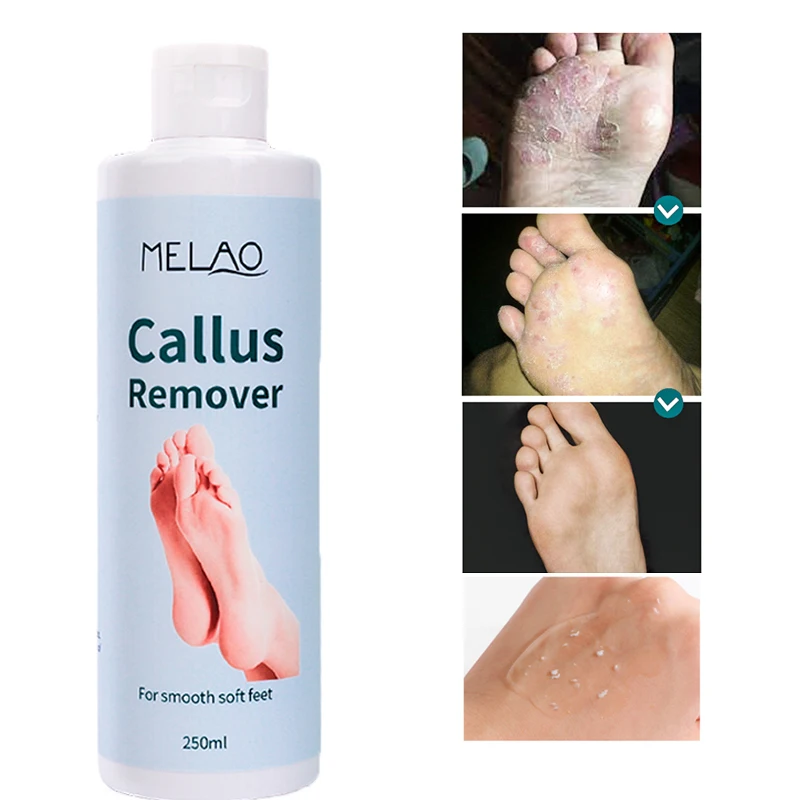 8oz Callus Remover gel for feet for a professional pedicure. Better results  than, foot file, pumice stone, foot scrubber, foot buckets & callus shaver.  Rid ugly callouses from feet in 