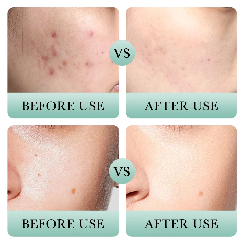 BIOAQUA Anti Acne Serum Cleansing Hydrating Oil Control Facial Cleanser Anti Acne Cream Skin Care Face Mask Sheet Crystal Female
