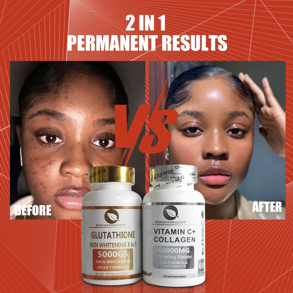 glutathione steroid Do Skin Whitening Injections Really Work? Myths vs. Facts You Need to Know