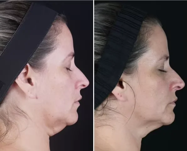 Adelgazamiento 980 1470nm Vaser Liposucción Máquina 1470nm Diodo Láser  Lipólisis Lipo Láser Eliminación de grasa Máquina de belleza Cánulas de  fibra - Main Image