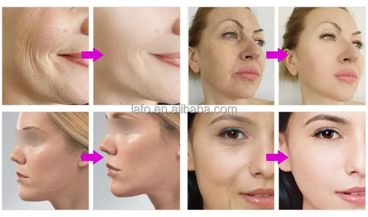 Professional Skin Firming Facial Forehead Muscle Tone Wrinkle Reduction EMRF Facelift Pe-Face Eyebag Removal Machine For