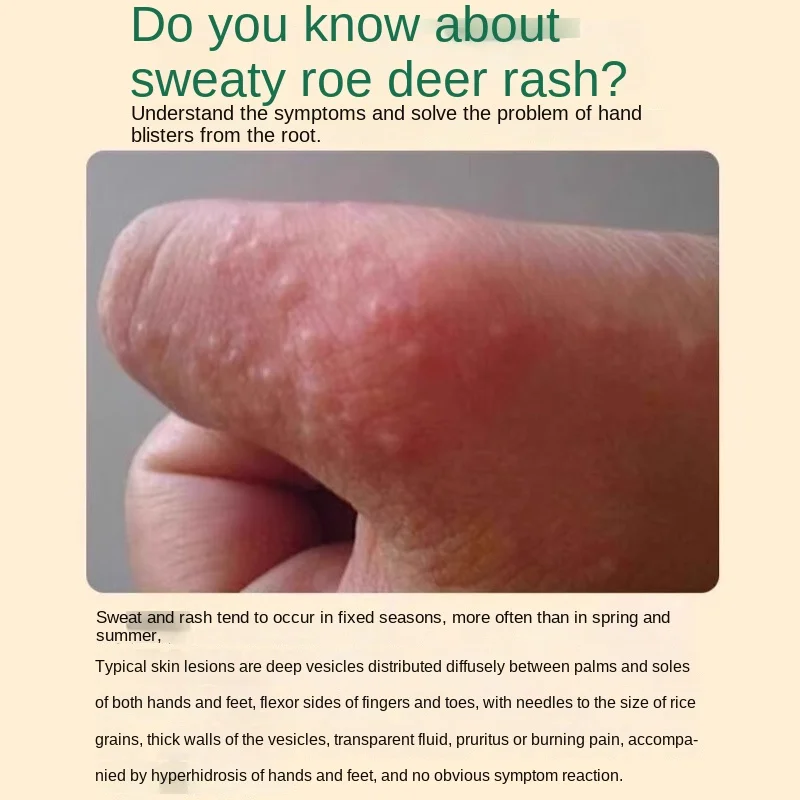 Topical Cream for Skin Sweat Herpes Itching Relief Anti-Ich Hand Foot Cream Chinese Plaster Product Category