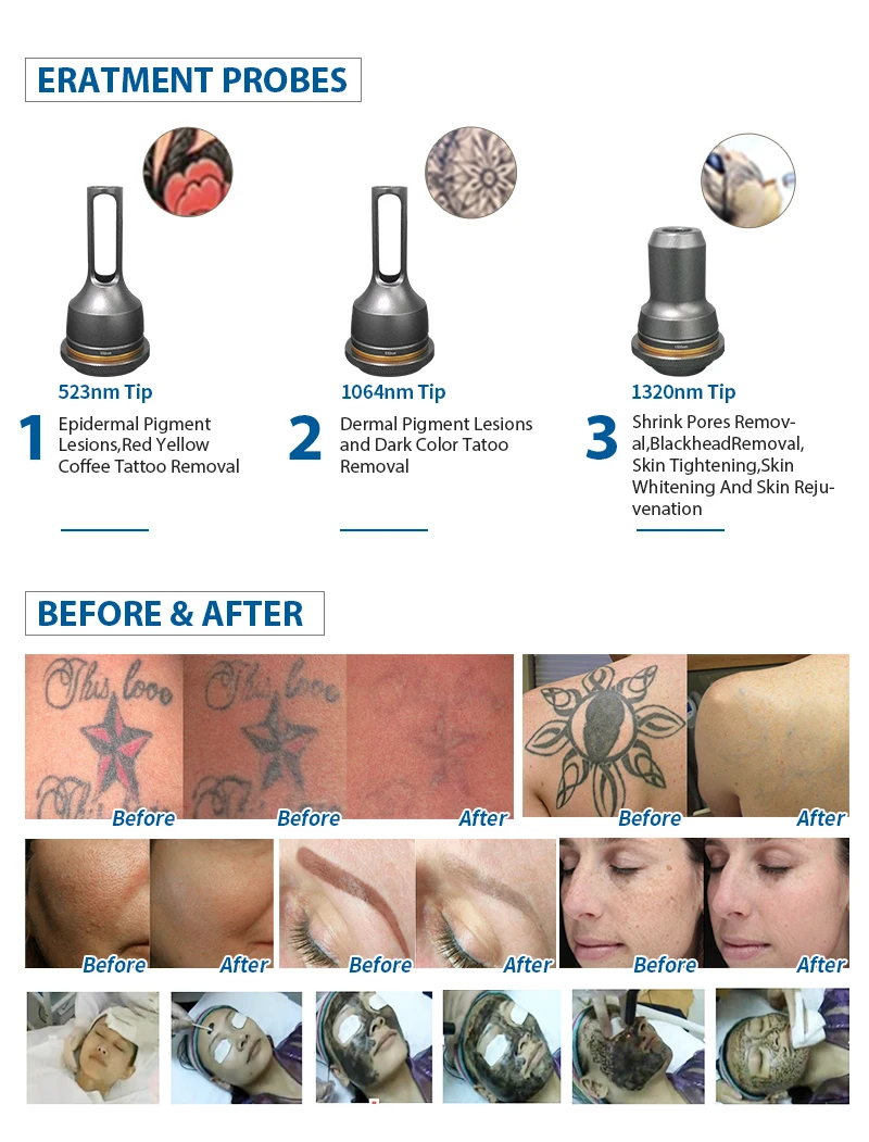 Q Switch laser removal of tattoos