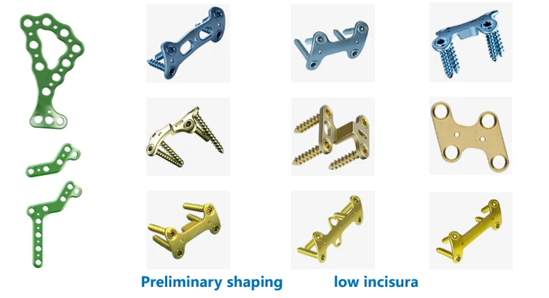 Basic Orthopedics Implant Locking Ankle Plate Instrument Set for Foot ...