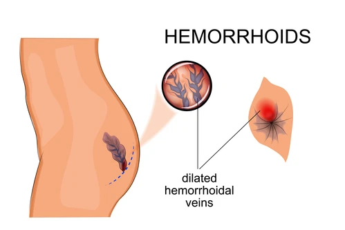 Hemorrhoid-Illustration-1.jpg