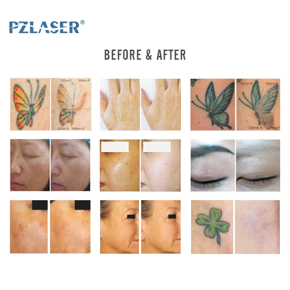 PZLASER Effective Portable Pico Laser 532nm 1064nm 1320nm Picosecond Q Switch Nd Yag Laser Machine Remove Tattoo