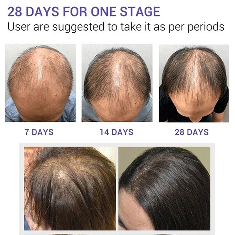 Женское и мужское средство против выпадения волос Органическая травяная Сыворотка для роста натуральная Фирменная торговая марка травяное лучшее