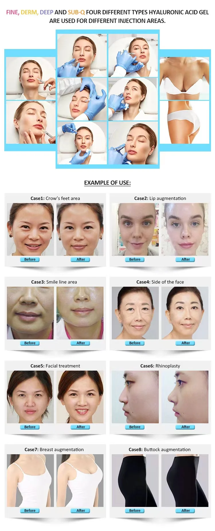 Hereme lips augmentation nose cheek HA gel injection cross-linked hyaluronic acid dermal filler for lip injections