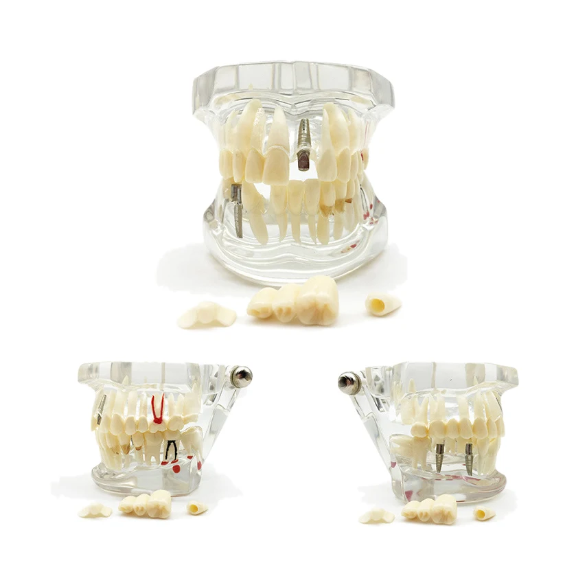 Detachable Dental Pathology Study Models Implant Restoration Models for Dental Teaching Doctor-patient Communication