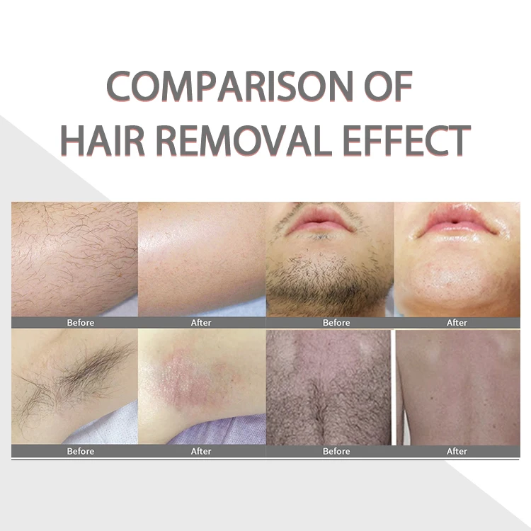 2025 Newest Model Diode Laser Machine 755 808 1064 Diode Triple Wave Portable Laser Hair Removal 3000w Painless 808 Diode Laser