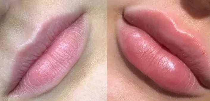 Hot sale acido hialuronico inyectable dermal lip filler injection hyaluronic acid filler for lip injections