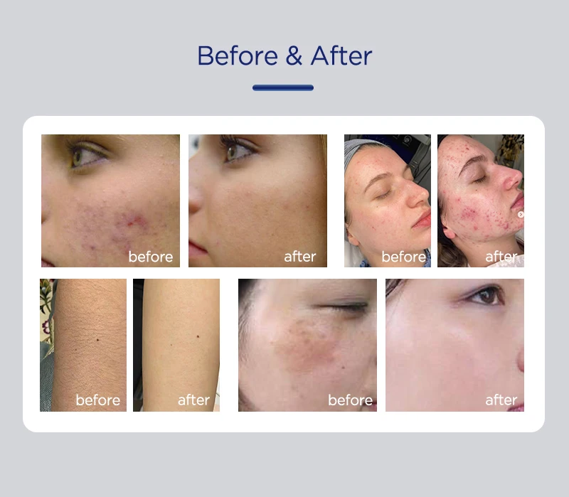 Medicina Estética Ipl Facial Manchas Medicina Estética Luz Pulsada