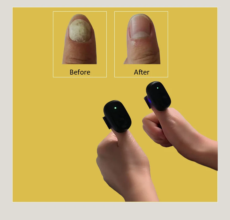 Nail Fungus Laser