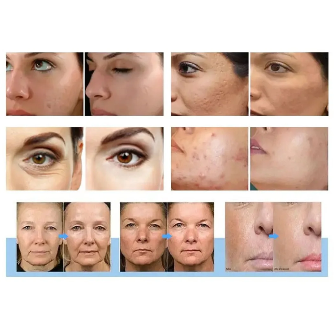 RF Microneedle 40pin Needle Skin Tighten Wrinkle Remove Machine Rf Microneedling Device Microneedling Rf Fractional Resurfacing